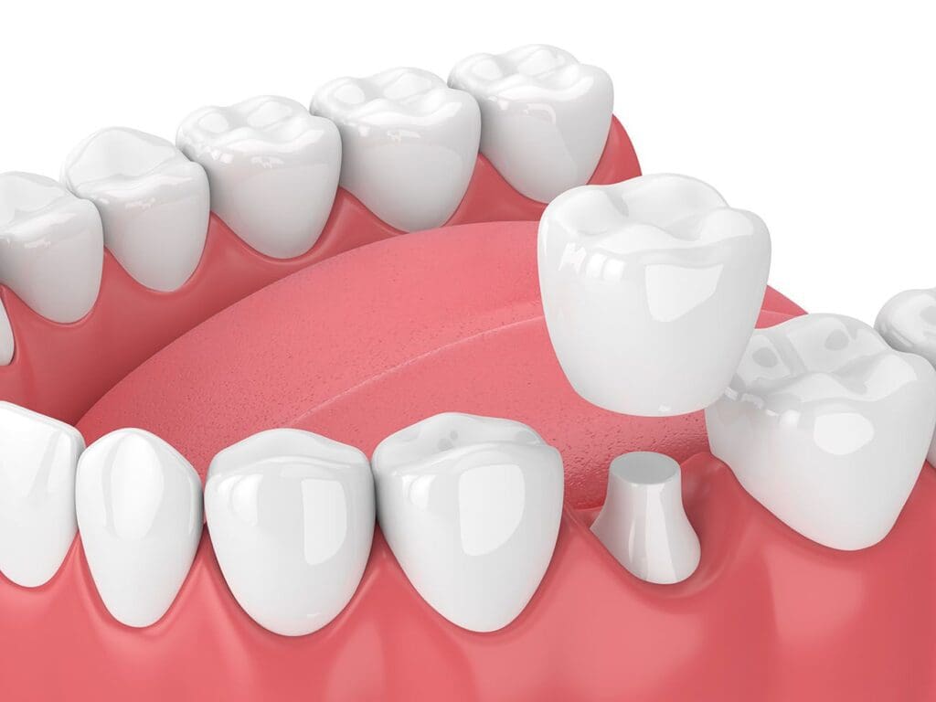 Dental Crowns in Lyndhurst NJ
