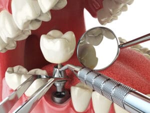 DENTAL IMPLANTS in LYNDHURST NJ may not be available for every patient