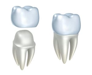 Dental crowns serve as a viable solution for salvaging teeth severely affected by cavities or other damages.