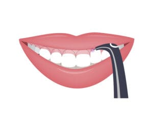 Understanding what to expect from laser dentistry can help you make informed decisions about your oral health.