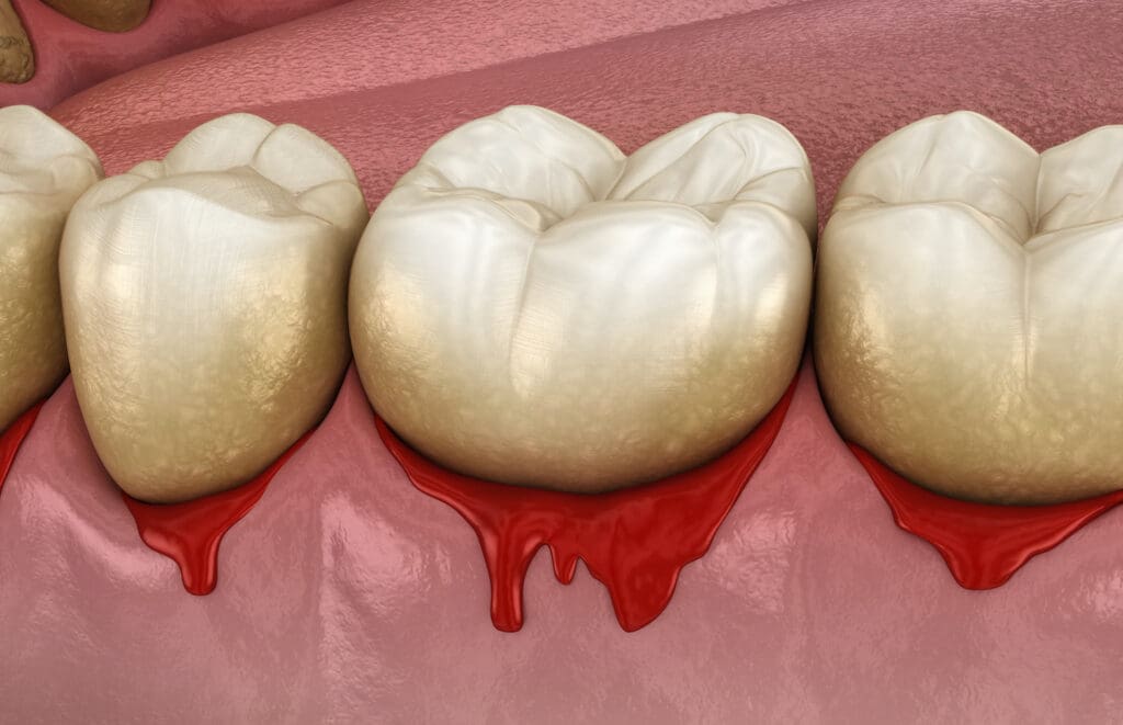 Gum Disease Treatment
