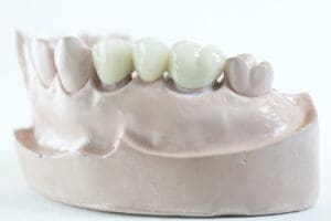 Understanding the differences in each dental bridge is crucial to help you make an informed decision on your oral health.