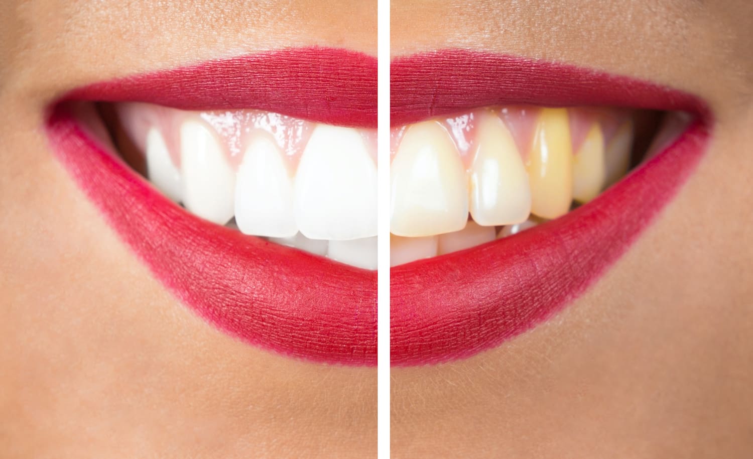 Do You Pay Teeth Whitening Cost Upfront or in Installments?
