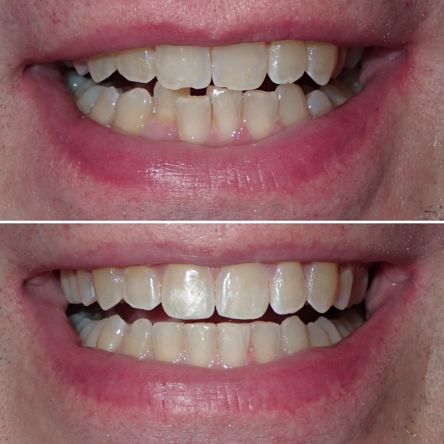Powder Ridge Invisalign Doctor Invisalign Provider in Lyndhurst, NJ at Ridge Family Dental