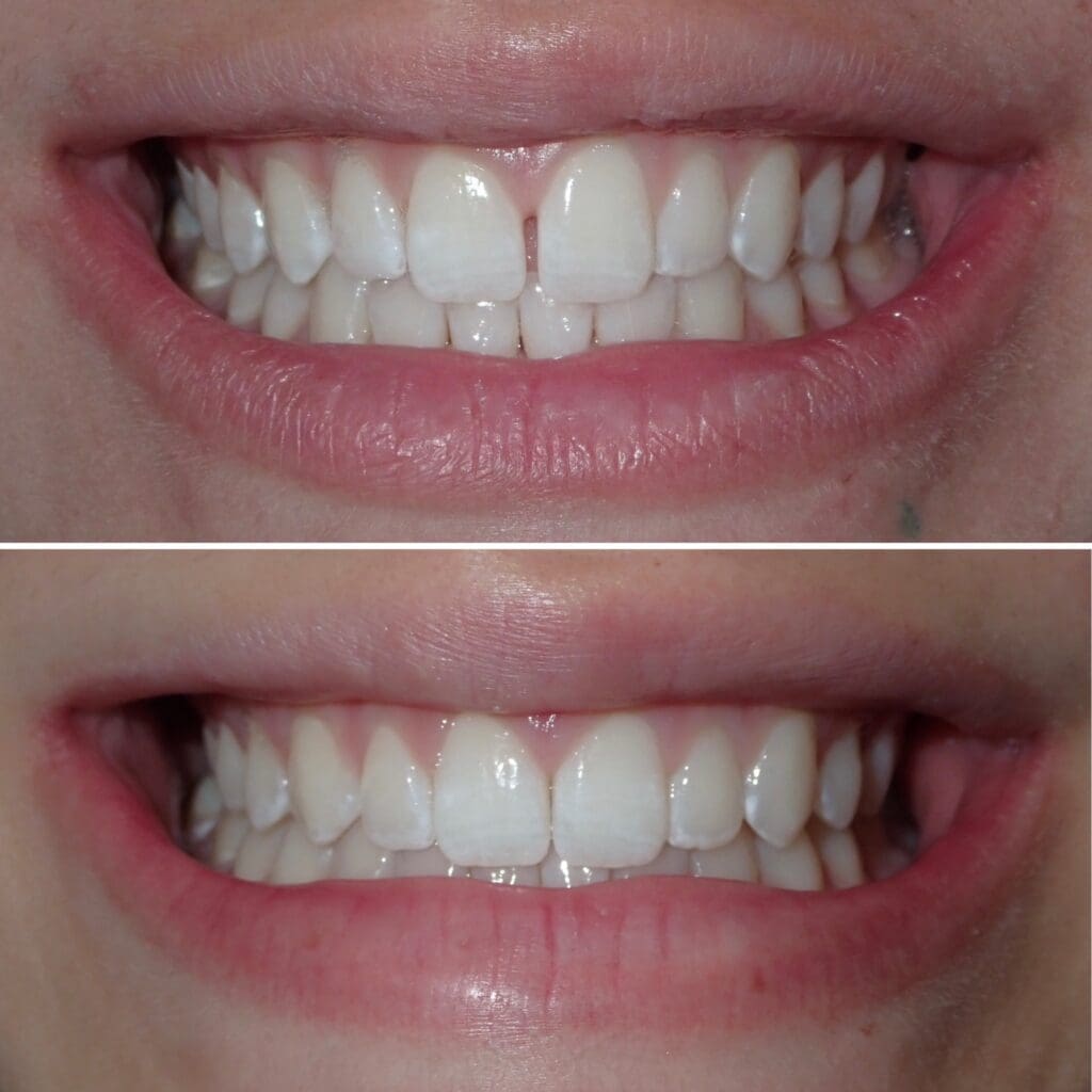 Invisalign Provider in Lyndhurst, NJ at Ridge Family Dental