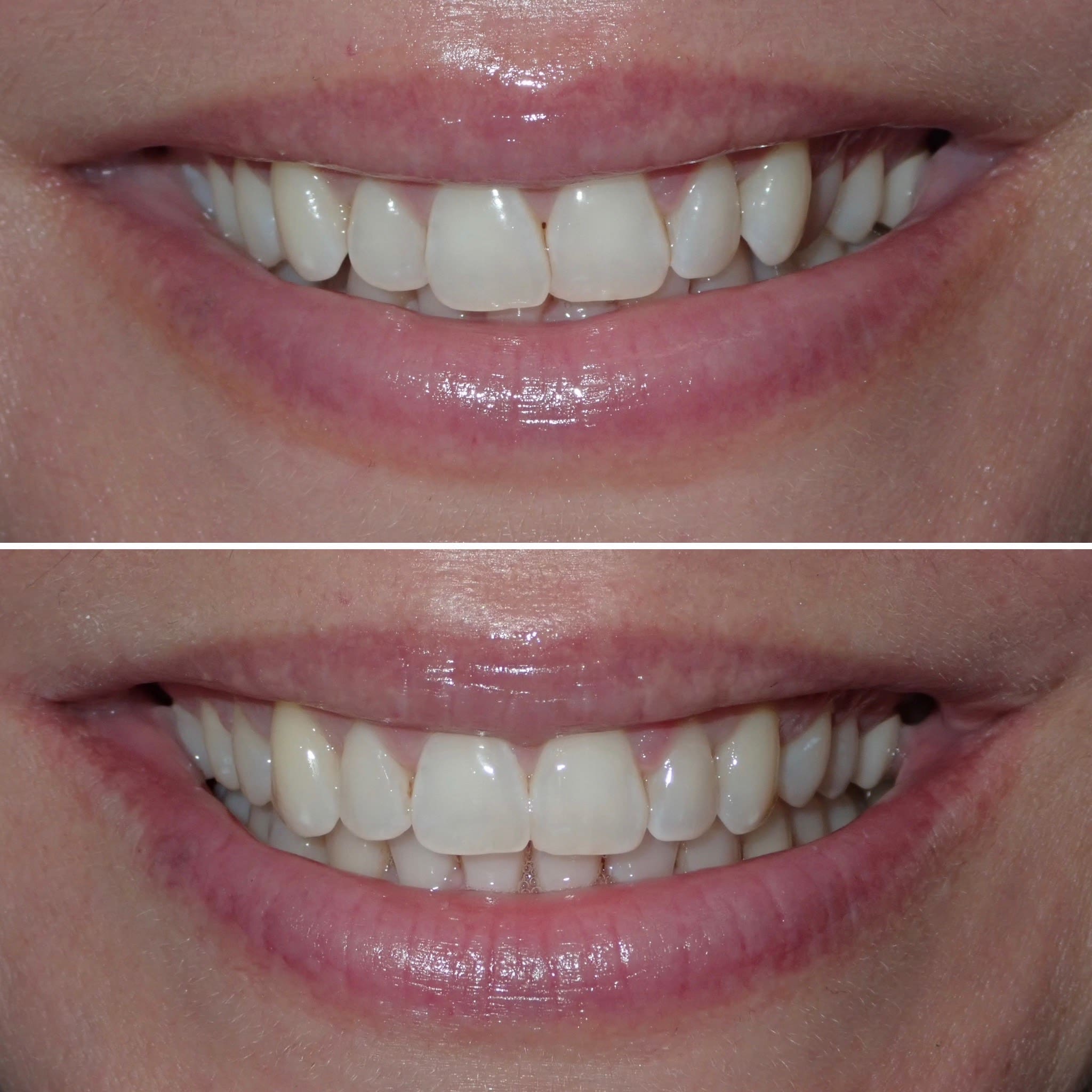 Powder Ridge Invisalign Invisalign Provider in Lyndhurst, NJ at Ridge Family Dental