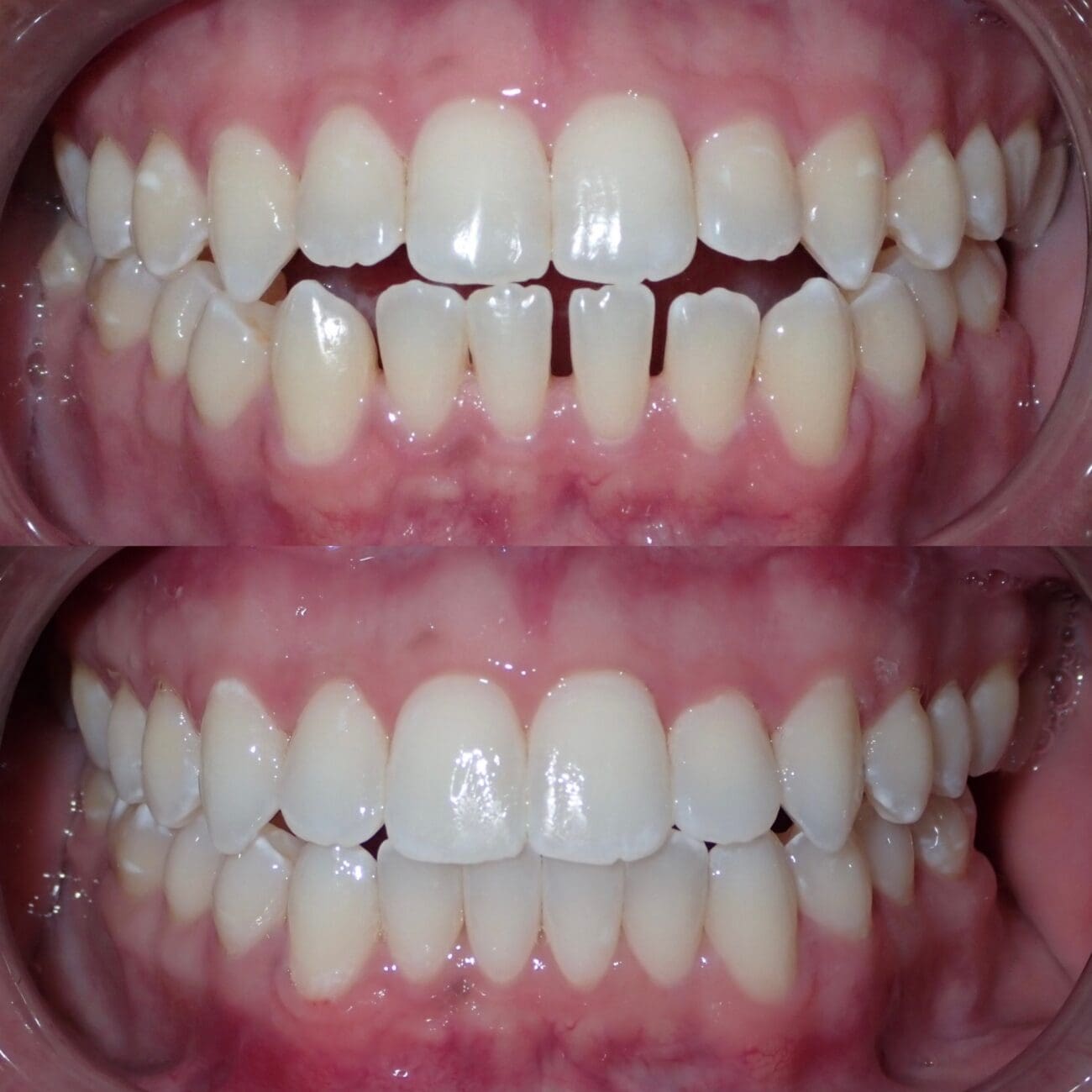 Powder Ridge Invisalign Invisalign Provider in Lyndhurst, NJ at Ridge Family Dental