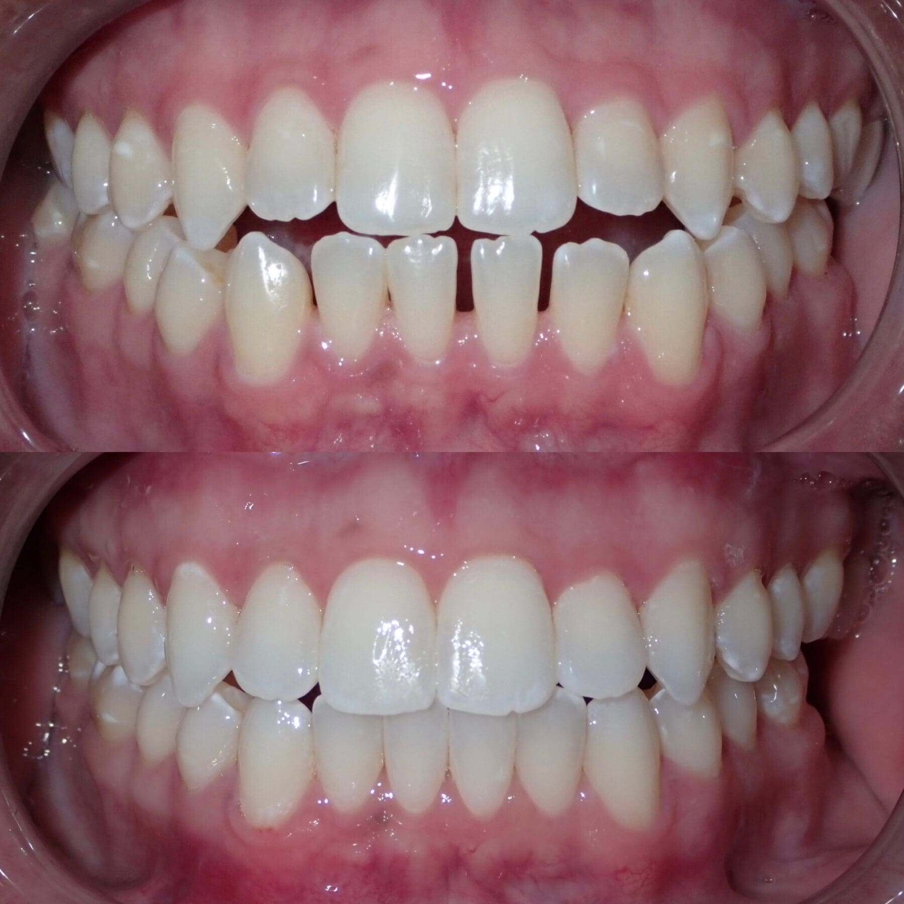 Invisalign Ridge Inside Invisalign Provider in Lyndhurst, NJ at Ridge Family Dental