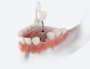 The Benefits of Replacing Missing Teeth in Lyndhurst, NJ